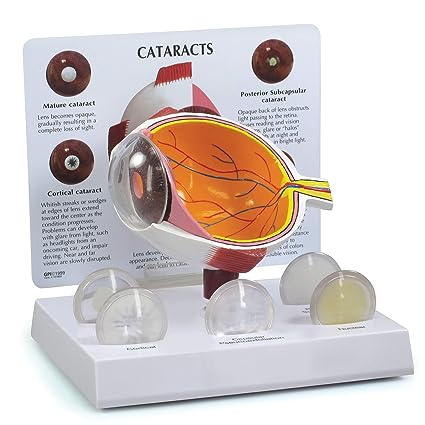 ​Cataract Eye Anatomical model